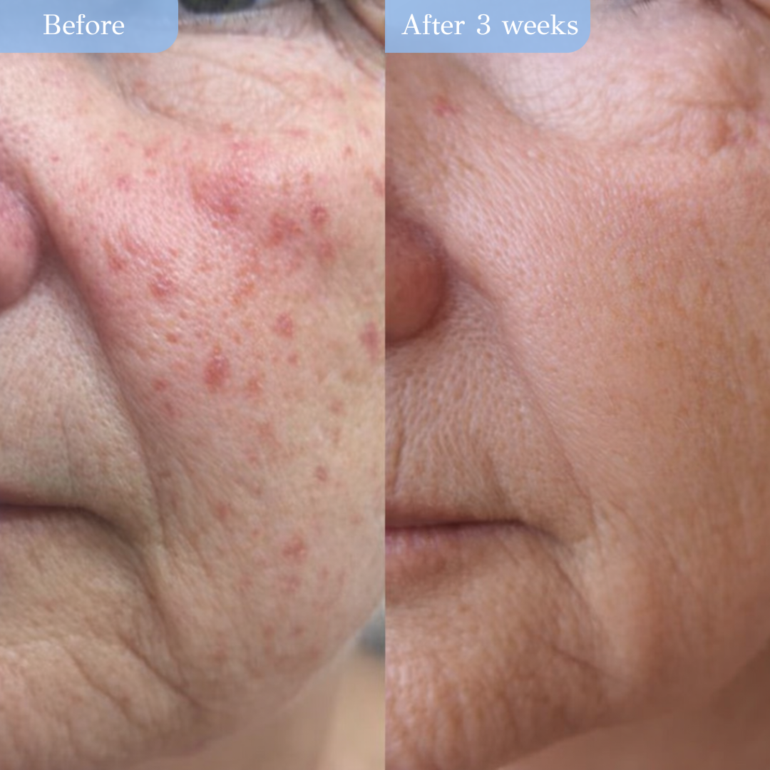 PDRN Infused Face Patches