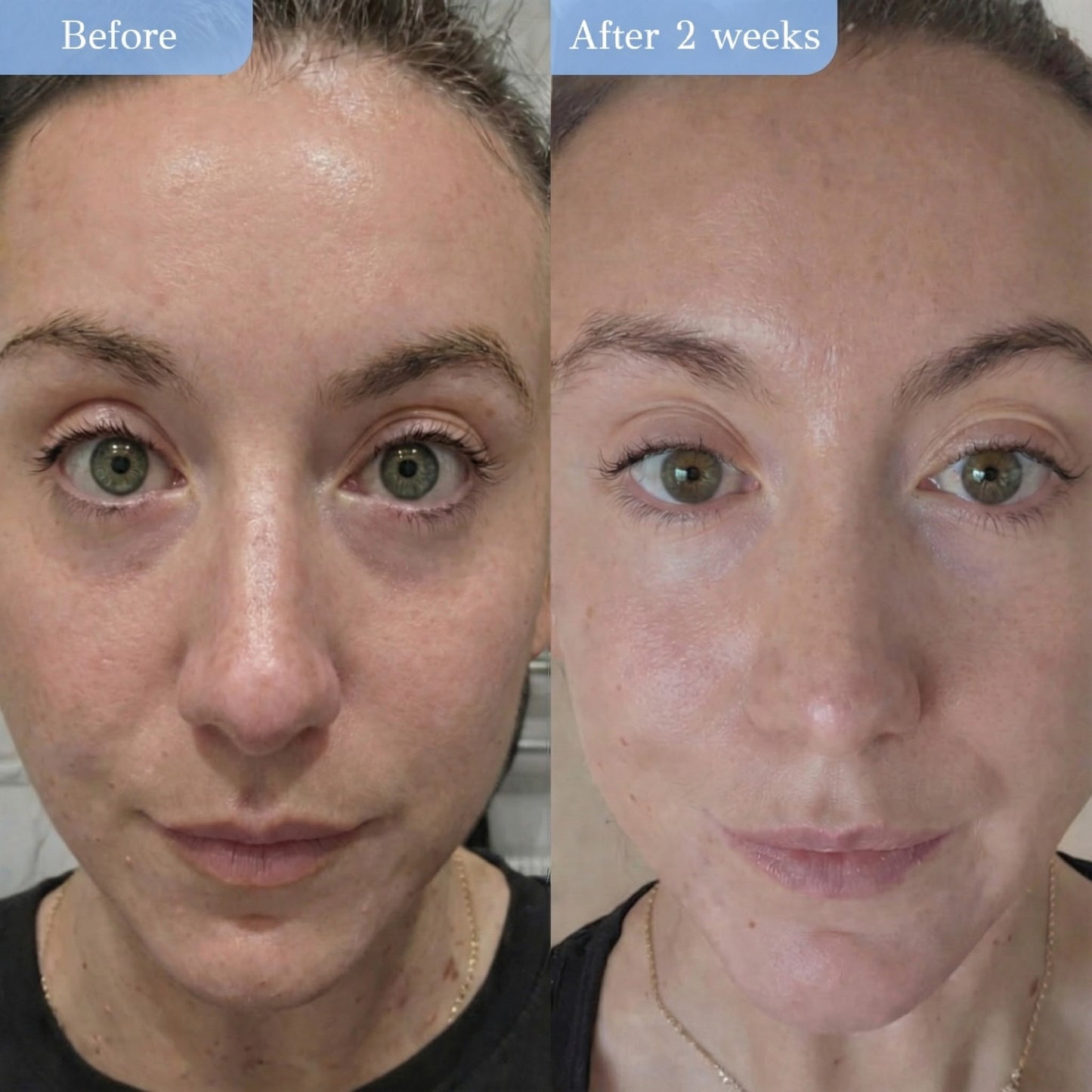 PDRN Infused Face Patches